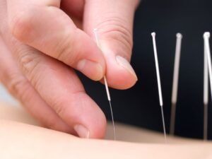 needling